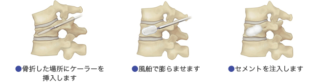 骨粗しょう症・脊椎圧迫骨折